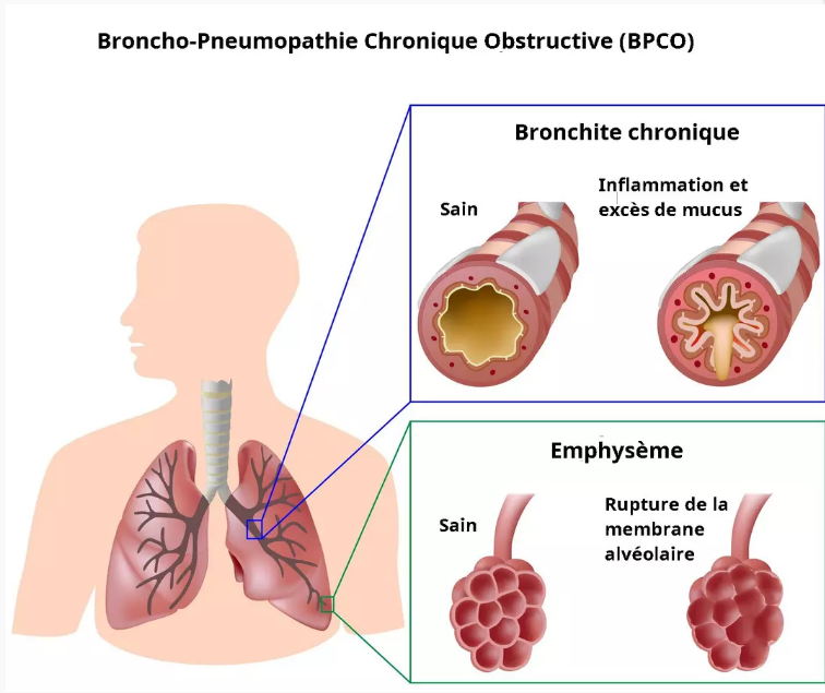 maladie pulmonaire obstructive chronique (MPOC)
