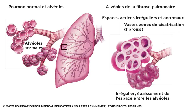 Fibrose pulmonaire